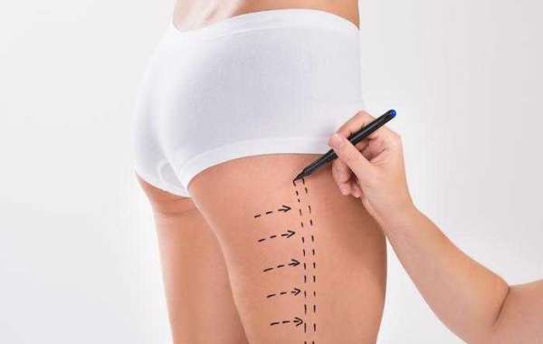 Financing Options for Liposuction Surgery