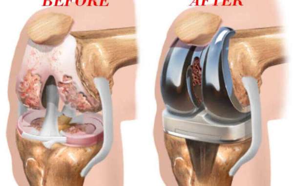 Top Clinics for Knee Replacement in Lahore: A Comprehensive Guide