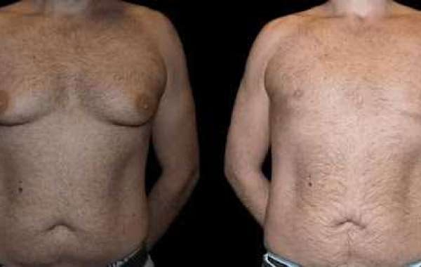 Recovery Timeline After Male Breast Reduction Surgery