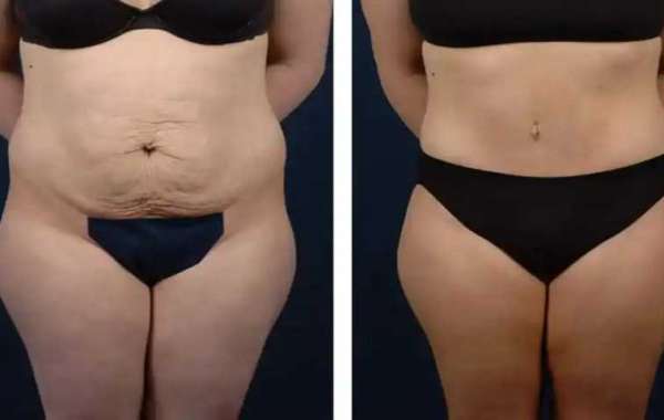 Tummy Tuck Consultation in Dubai: What to Expect