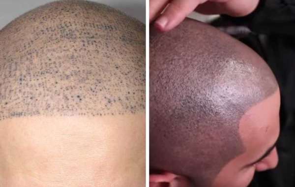 The Psychological Benefits of Scalp Micropigmentation