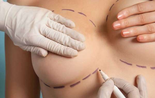 Medical Tourism for Breast Fat Transfer Procedures