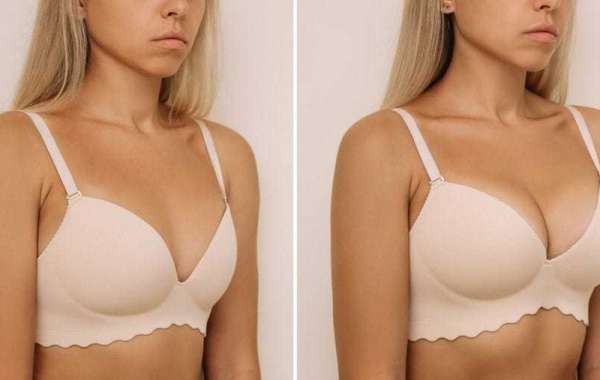 Before and After Real Results of Breast Augmentation in Dubai