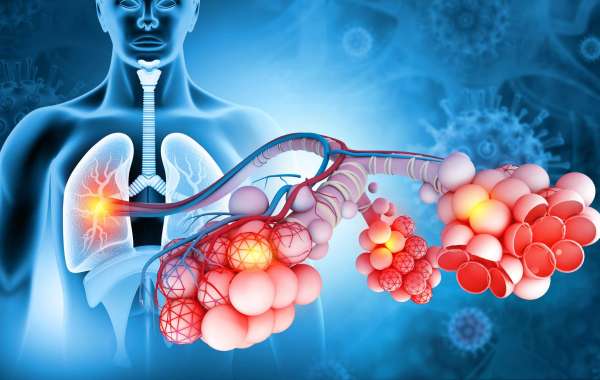 Multifocal Pneumonia: What It Is and How to Manage It