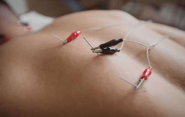 7 Reasons Why Electroacupuncture is Becoming Popular