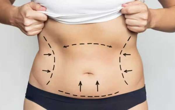 Post-Liposuction in dubai Care: Essential Tips for a Smooth Recovery